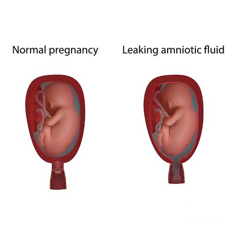 leaking fluid pregnancy|Leaking amniotic fluid (premature rupture of membranes)